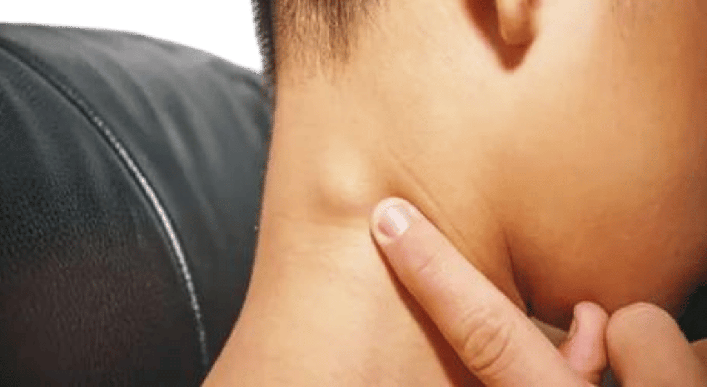 Is there a lump in your neck, back, or behind your ear? Here’s what you should know.