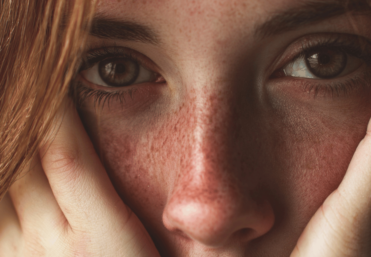 Warning Signs of Lupus You Need to Know