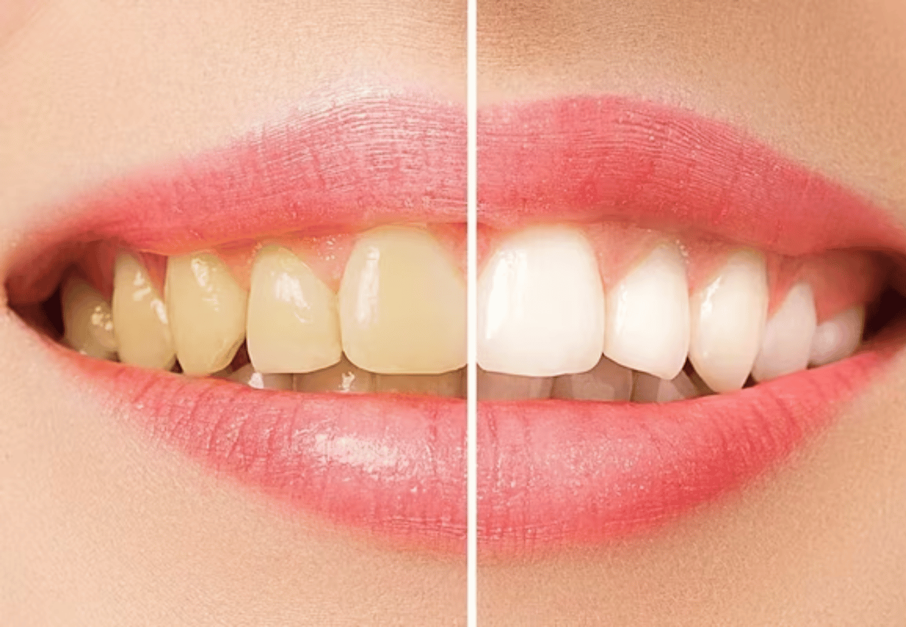 A Dentist Friend Told Me How to Eliminate Tartar, Gingivitis and Whiten My Teeth in 4 Steps With This Homemade Recipe