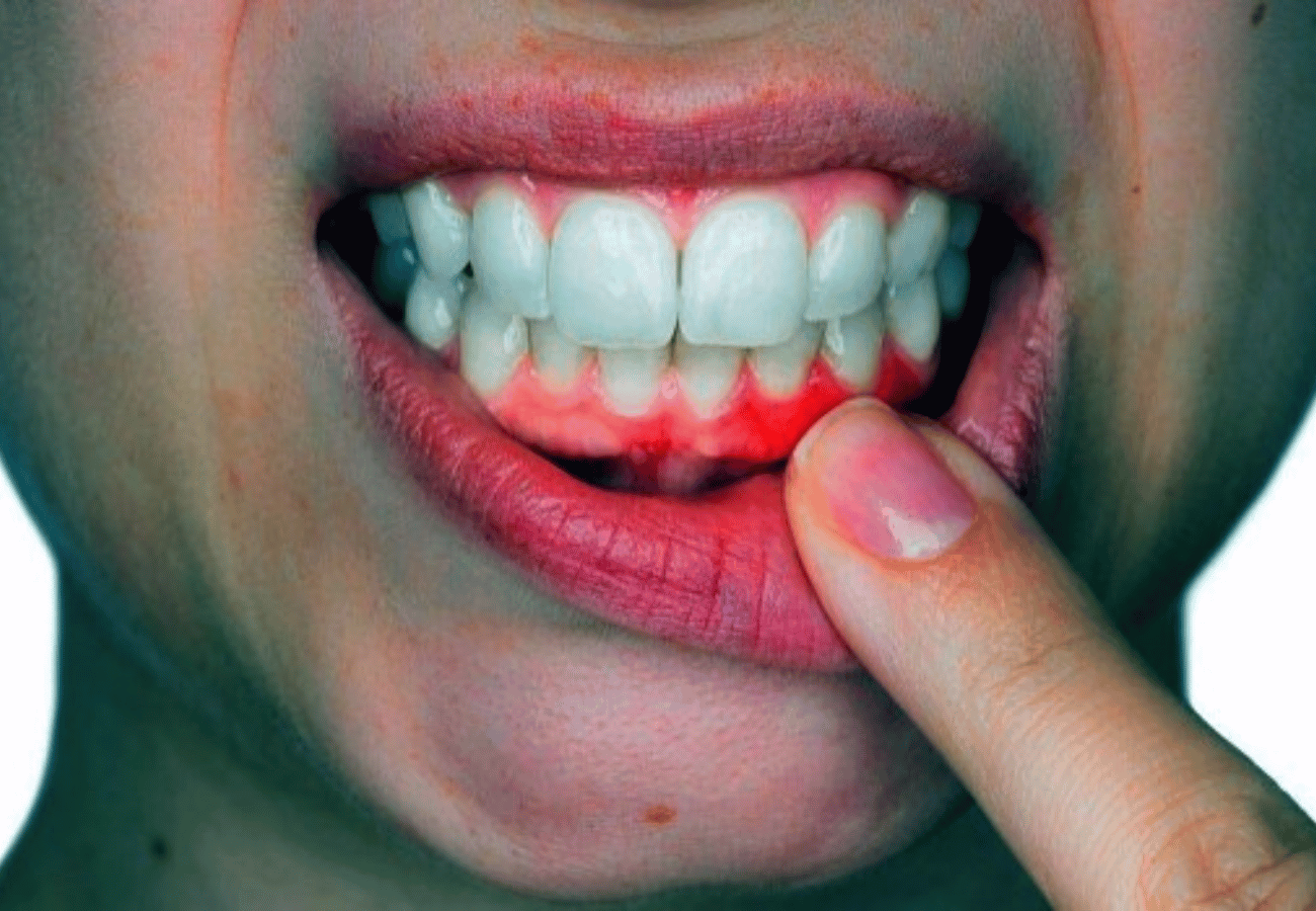 10 Easy Ways To Heal Receding Gums Naturally!